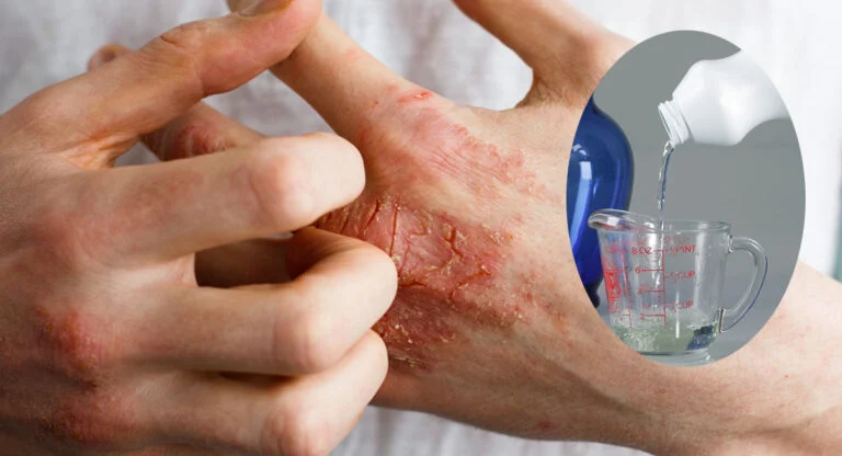 Remèdes naturels contre l'eczéma