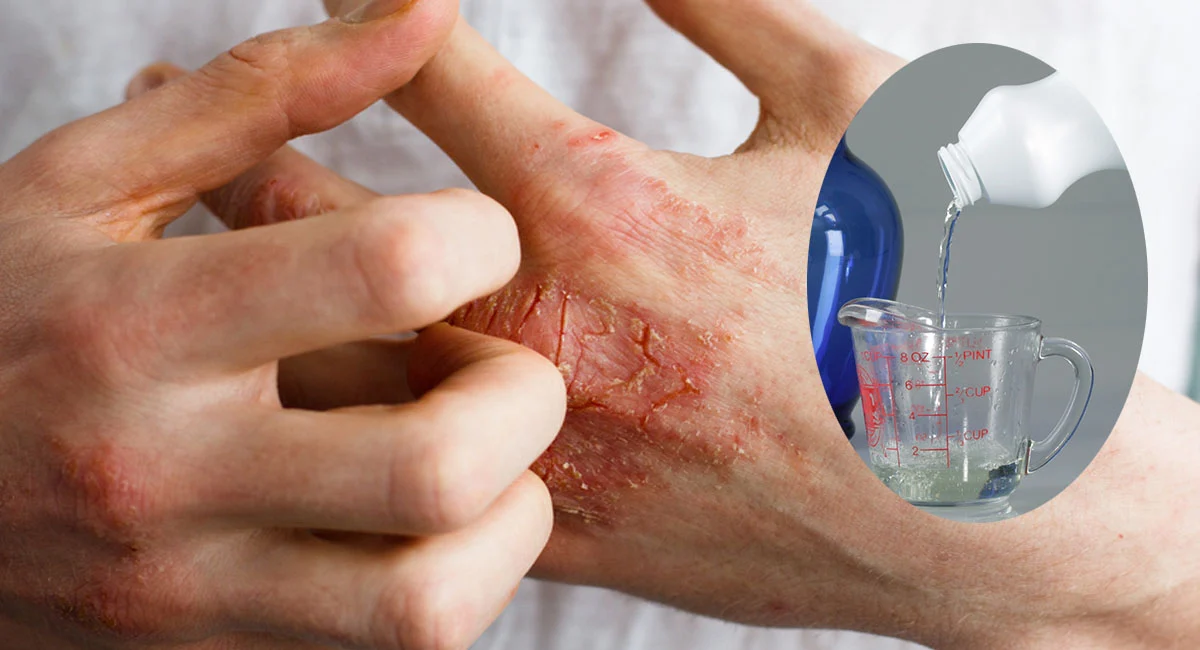 Eczéma 6 Remèdes naturels à domicile Remèdes naturels contre l'eczéma