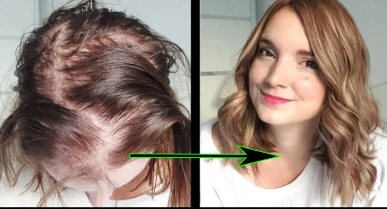 la chute de vos cheveux