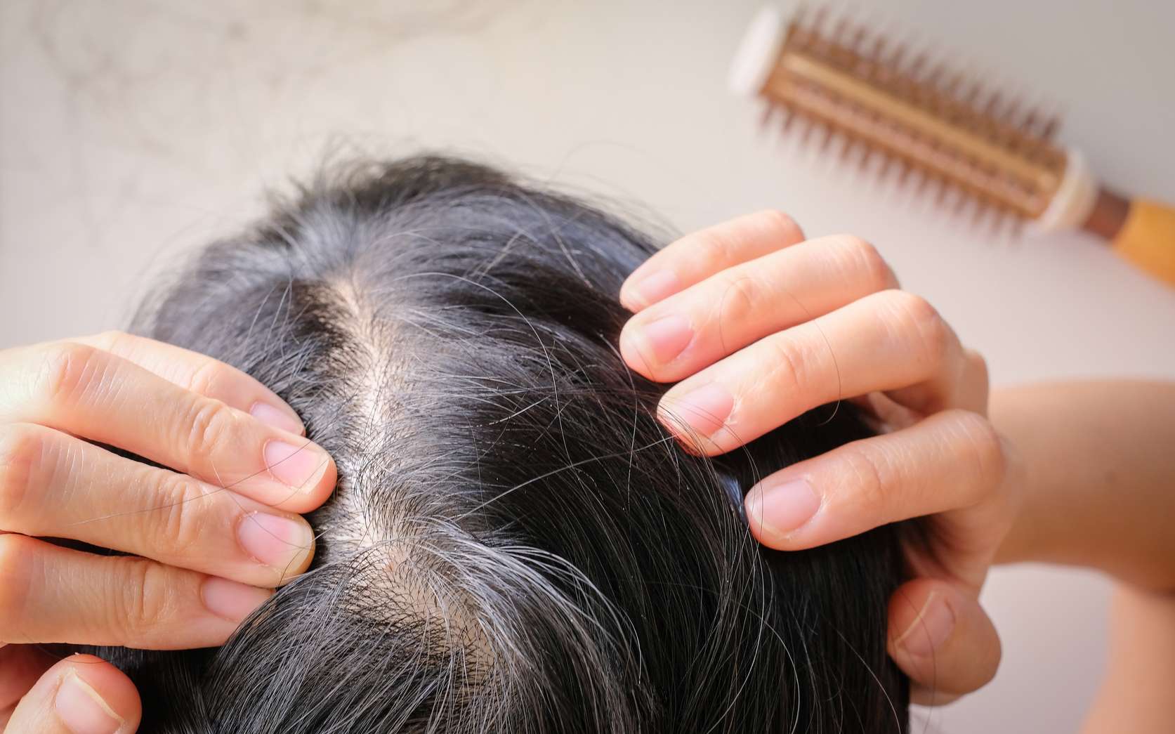Les facteurs liés à l’affinement et à la chute des cheveux