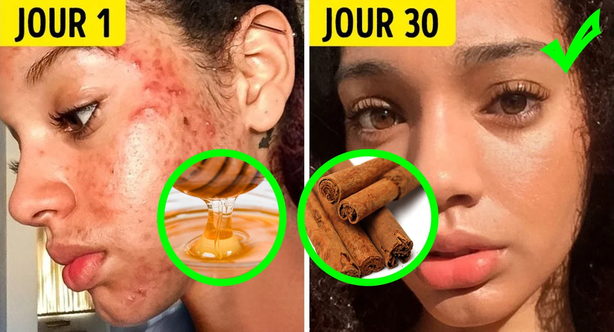 6 problèmes de peau et 6 masques DIY efficaces pour s’en débarrasser problemes de peau et masques naturels