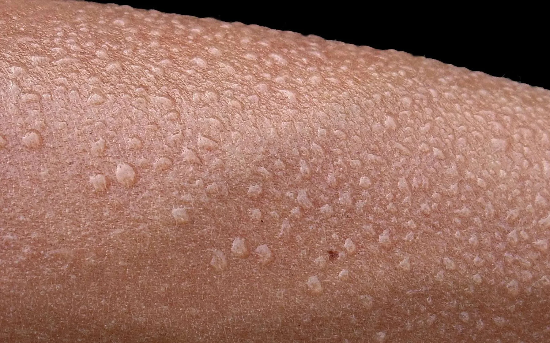 Les remèdes naturels contre l’hyperhidrose