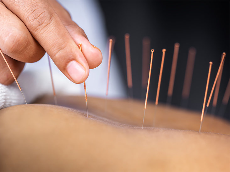 L'acupuncture