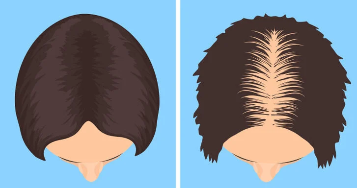 La perte ou l'affinement des cheveux