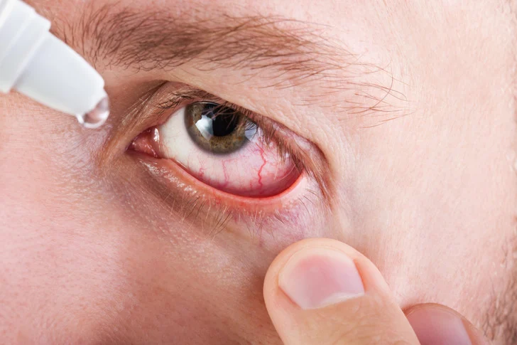 La sécheresse oculaire