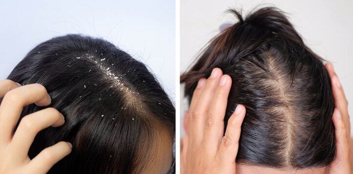 symptôme Les pellicules et la chute des cheveux