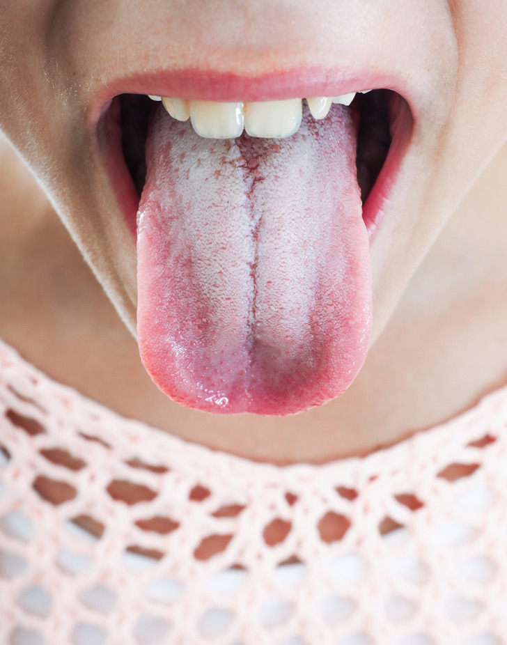 Les taches blanches sur la langue