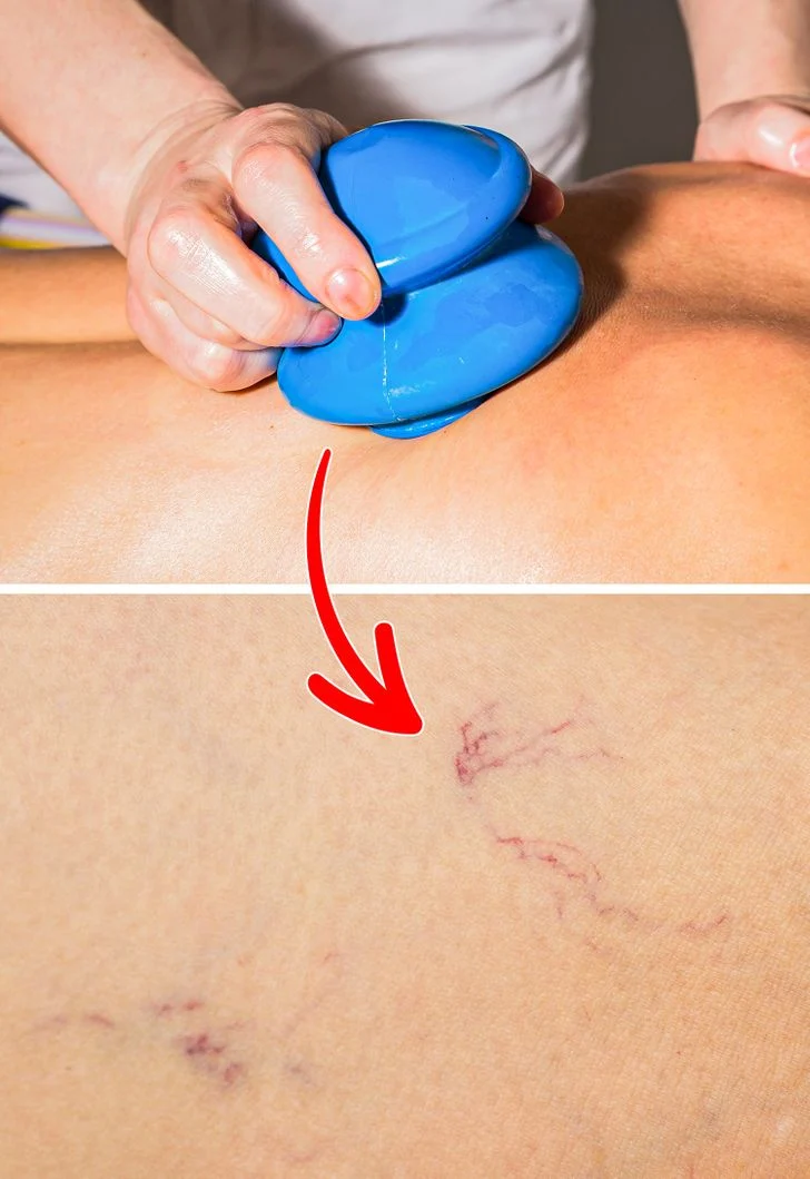 Pratiquer la technique de la ventouse