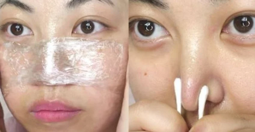 Tenter d'hydrater la peau et d'éliminer les points noirs avec de la Vaseline