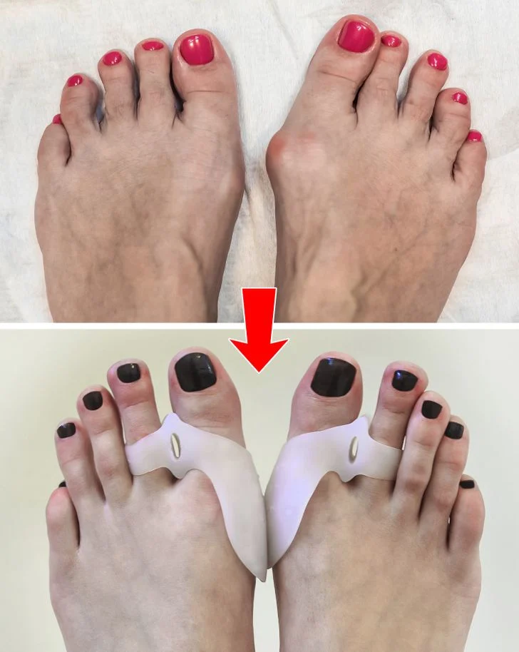 Utilisation d'écarteurs si vous avez l'oignon de pied