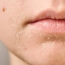 Qu'est-ce qui cause la peau cendrée