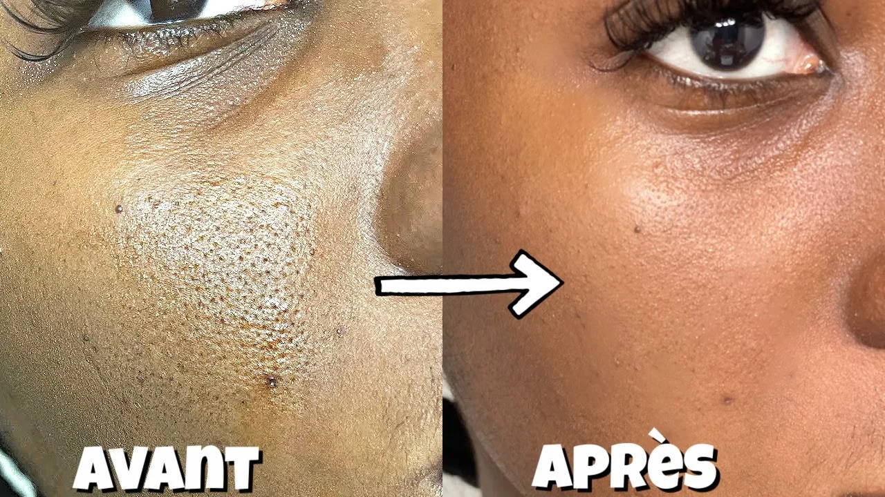 Traiter les pores dilatés