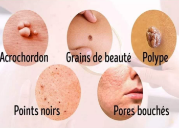 8 symptômes de maladie révélés par votre peau