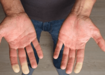 Maladie de Raynaud : causes, symptômes, traitements et complications