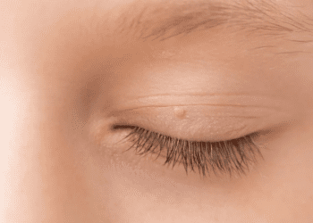 Verrue filiforme : paupière, nez, cause, traitement