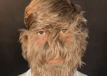 Atteint d'une maladie rare, cet ado de 18 ans décroche le record du visage le plus poilu au monde 17 Atteint d'une maladie rare, cet ado de 18 ans décroche le record du visage le plus poilu au monde Atteint d’une maladie rare, cet ado de 18 ans décroche le record du visage le plus poilu au monde