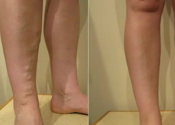 Comment éliminer les varices naturellement ?