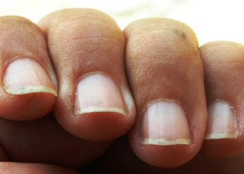 Ongles striés : ce qu’ils révèlent sur votre santé