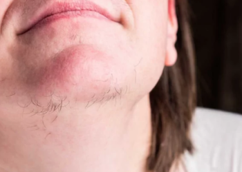 Poils au menton : Méthode naturelle pour les éliminer en douceur