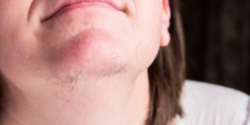 Poils au menton : Méthode naturelle pour les éliminer en douceur