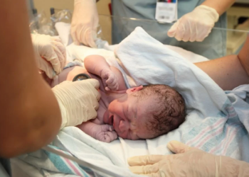 Un bébé est né avec une queue de 12 centimètres au Brésil, un cas rarissime