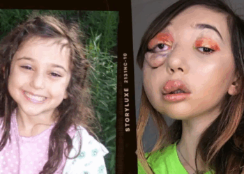 Nikki Lilly, militante au visage marqué par une maladie rare, bouleverse le tapis rouge de Cannes