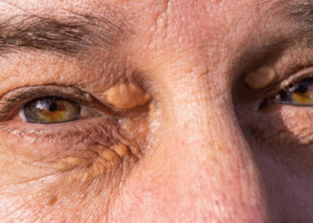 Xanthélasma : connaître les causes, la prévention et le traitement