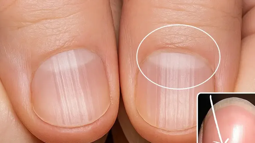 Ce détail sur vos ongles que votre médecin observe en premier 6 Ce détail sur vos ongles que votre médecin observe en premier 6d47e094 c1e5 48e1 986f 4f6cb8024849