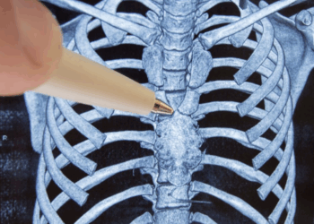 Le thymome, un cancer rare qui touche le thymus