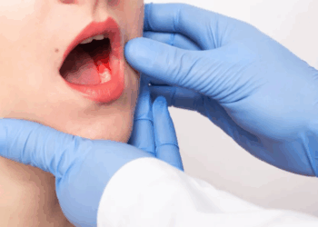 Cancer buccal : Les 5 symptômes d’alerte à ne pas négliger