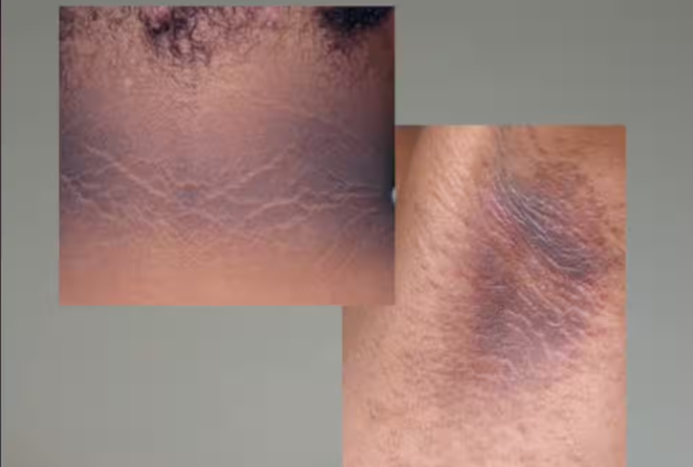 Risques de cancer: vous devriez consulter si vous avez ces taches sur votre corps 2 Risques de cancer: vous devriez consulter si vous avez ces taches sur votre corps Capture decran 2025 09 24 165359