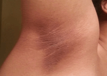 Risques de cancer: vous devriez consulter si vous avez ces taches sur votre corps