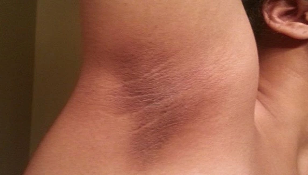 Risques de cancer: vous devriez consulter si vous avez ces taches sur votre corps 3 Risques de cancer: vous devriez consulter si vous avez ces taches sur votre corps Capture decran 2025 09 24 165406