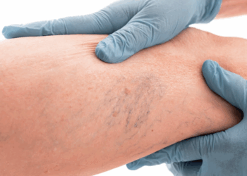 Qu&rsquo;est-ce que l&rsquo;insuffisance veineuse chronique, la maladie dont souffre Donald Trump ?