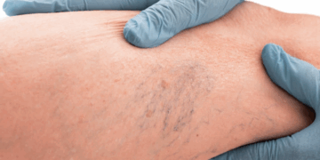 Qu'est-ce que l'insuffisance veineuse chronique, la maladie dont souffre Donald Trump ? 13 Qu'est-ce que l'insuffisance veineuse chronique, la maladie dont souffre Donald Trump ? Qu’est-ce que l’insuffisance veineuse chronique, la maladie dont souffre Donald Trump ?