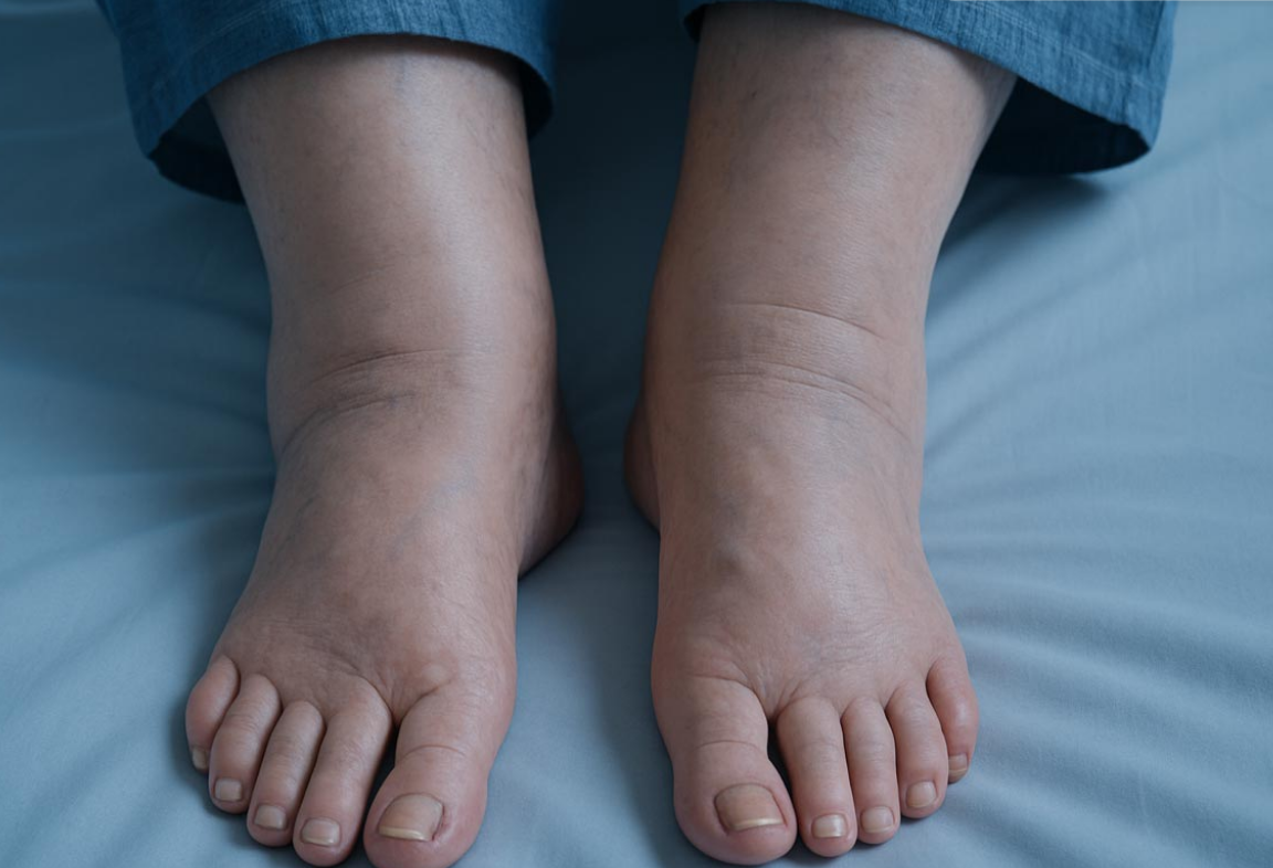 Une grave maladie révélée par un symptôme touchant les pieds et chevilles 3 Une grave maladie révélée par un symptôme touchant les pieds et chevilles Capture decran 2025 10 08 201757