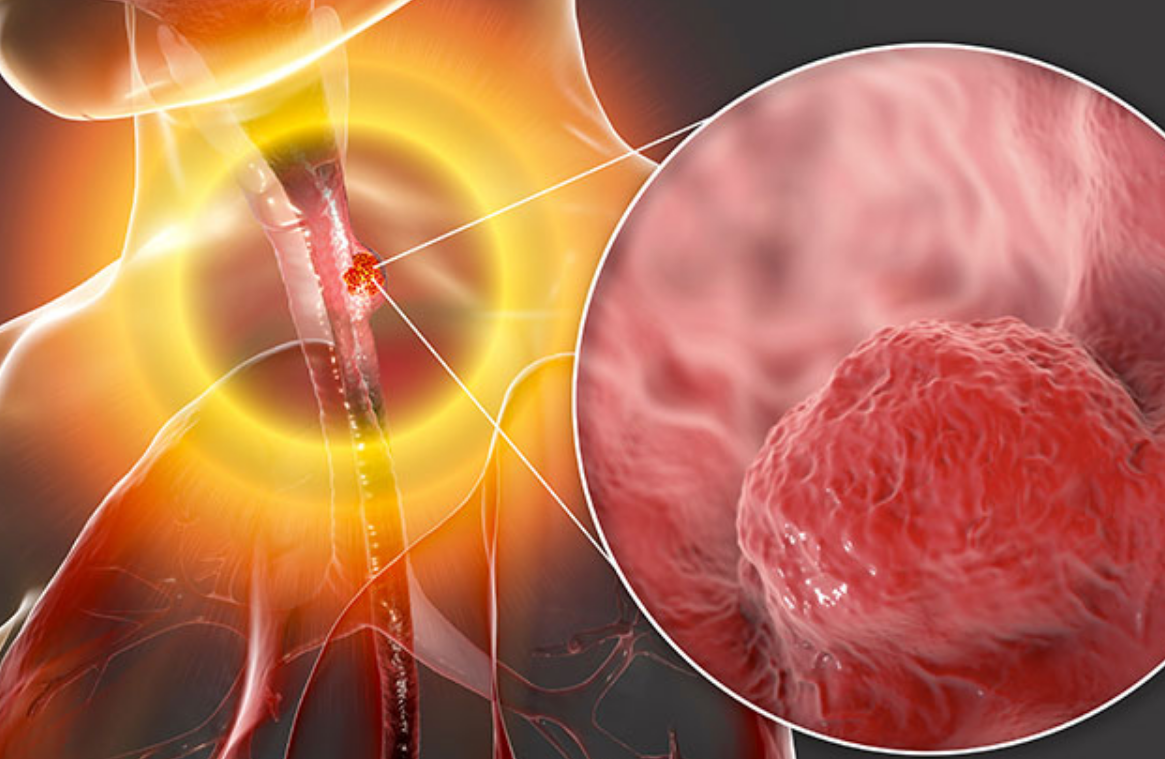 Cancer de l’œsophage : ces signes avant-coureurs qui doivent alerter 2 Cancer de l’œsophage : ces signes avant-coureurs qui doivent alerter Capture decran 2025 10 08 203012