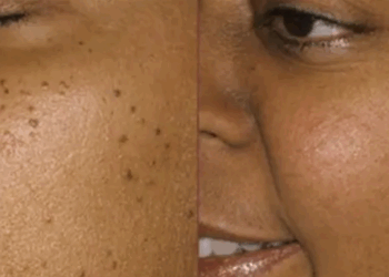 Dites adieu aux acrochordons du visage grâce à la peau de banane