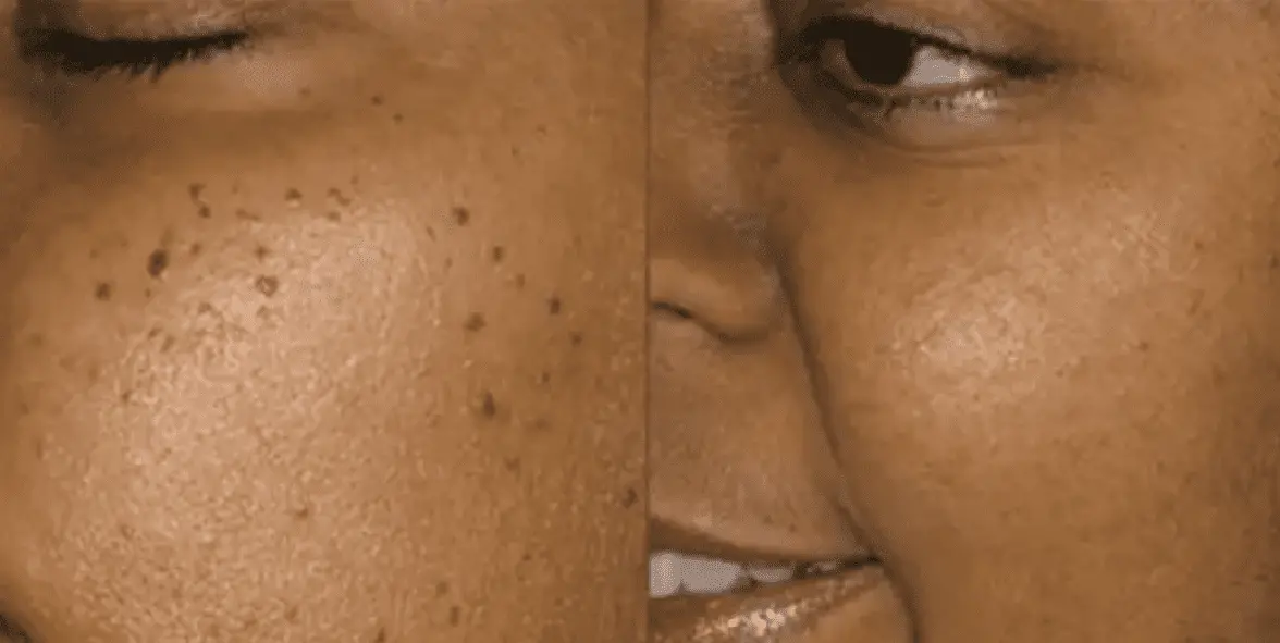 Dites adieu aux acrochordons du visage grâce à la peau de banane