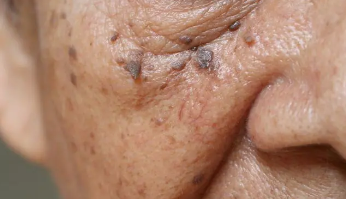 Dites adieu aux acrochordons du visage grâce à la peau de banane 2 Dites adieu aux acrochordons du visage grâce à la peau de banane Capture decran 2025 10 28 153815