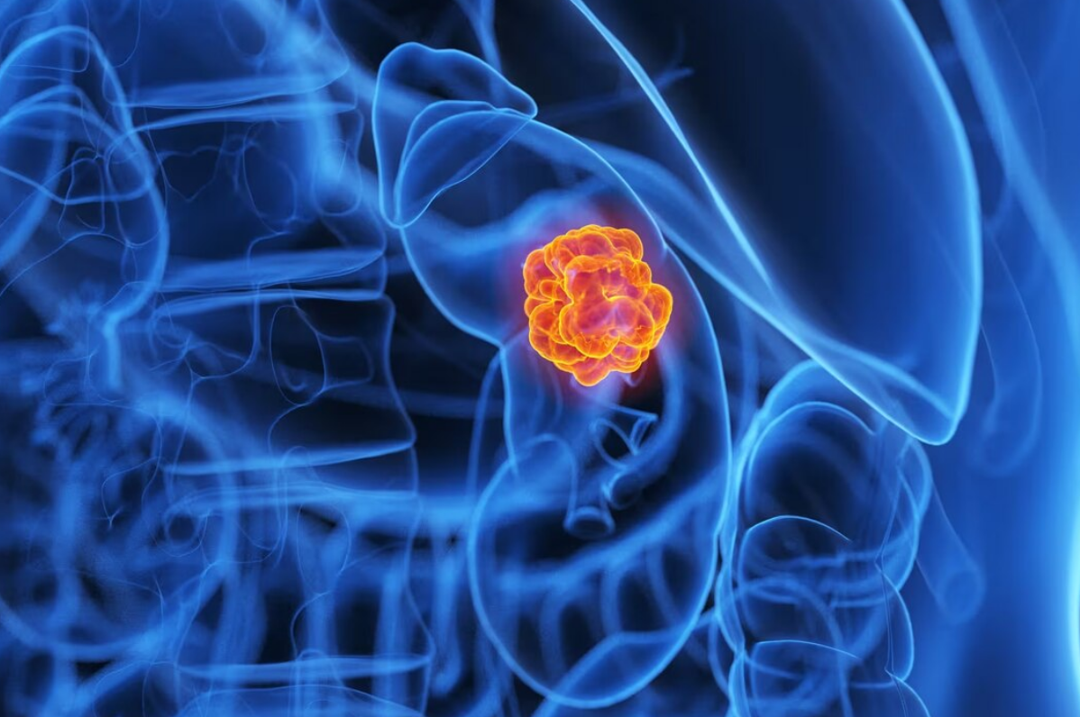 Cancers : une augmentation de 80 % en trois décennies chez les moins de 50 ans… pourquoi les diagnostics grimpent autant chez les jeunes ? 4 Cancers : une augmentation de 80 % en trois décennies chez les moins de 50 ans… pourquoi les diagnostics grimpent autant chez les jeunes ? Capture decran 2025 10 28 213605