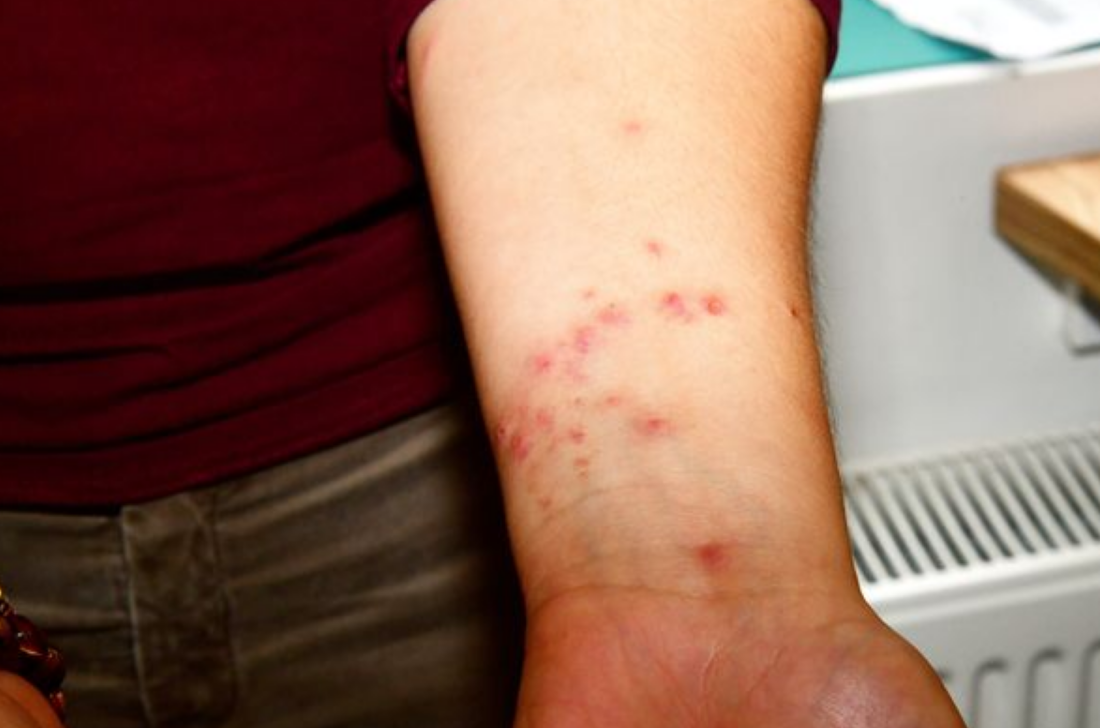 Invasion de punaises de lit à Paris : "Totalement bouffée", à 76 ans, cette actrice culte vit un cauchemar 4 Invasion de punaises de lit à Paris : "Totalement bouffée", à 76 ans, cette actrice culte vit un cauchemar Capture decran 2025 11 12 165456