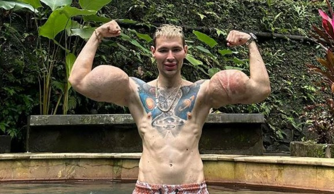 Il s’était gonflé les bras en y injectant plusieurs litres d’huile : le "Popeye russe" risque désormais de les perdre 2 Il s’était gonflé les bras en y injectant plusieurs litres d’huile : le "Popeye russe" risque désormais de les perdre Capture decran 2025 11 25 175519