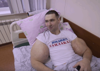 Il s’était gonflé les bras en y injectant plusieurs litres d’huile : le "Popeye russe" risque désormais de les perdre 7 Il s’était gonflé les bras en y injectant plusieurs litres d’huile : le "Popeye russe" risque désormais de les perdre Il s’était gonflé les bras en y injectant plusieurs litres d’huile : le « Popeye russe » risque désormais de les perdre