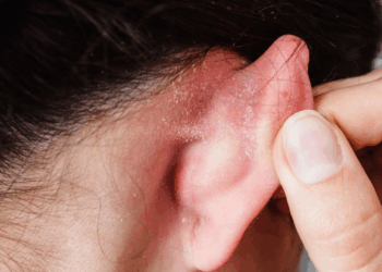 Mon enfant a de l’eczéma dans l’oreille. Comment le soigner ?