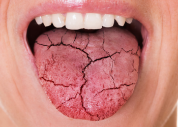 J&rsquo;ai la bouche sèche la nuit et pâteuse au réveil : quelles sont les causes (et que faire) ?