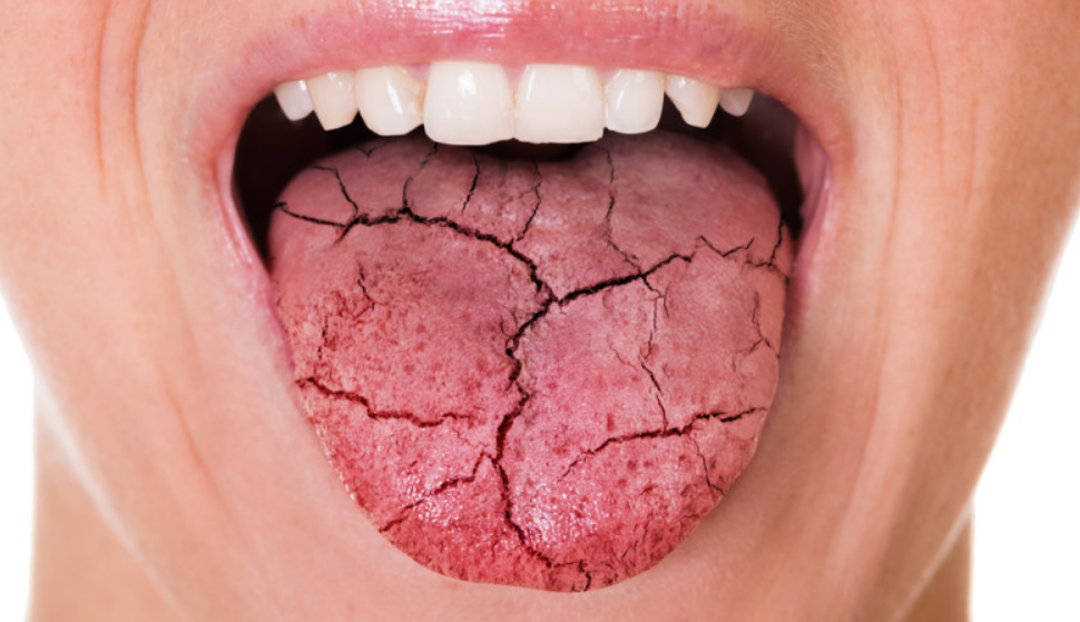 J&rsquo;ai la bouche sèche la nuit et pâteuse au réveil : quelles sont les causes (et que faire) ?