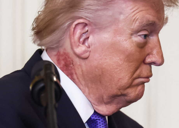 Donald Trump malade ? Une éruption cutanée sur son cou causée par « un traitement préventif pour la peau » réitère les spéculations