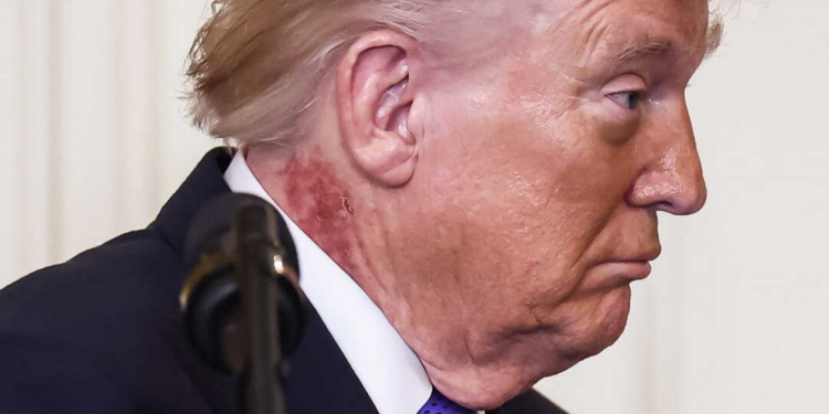 Donald Trump malade ? Une éruption cutanée sur son cou causée par "un traitement préventif pour la peau" réitère les spéculations 1 Donald Trump malade ? Une éruption cutanée sur son cou causée par "un traitement préventif pour la peau" réitère les spéculations Capture decran 2026 03 03 120107