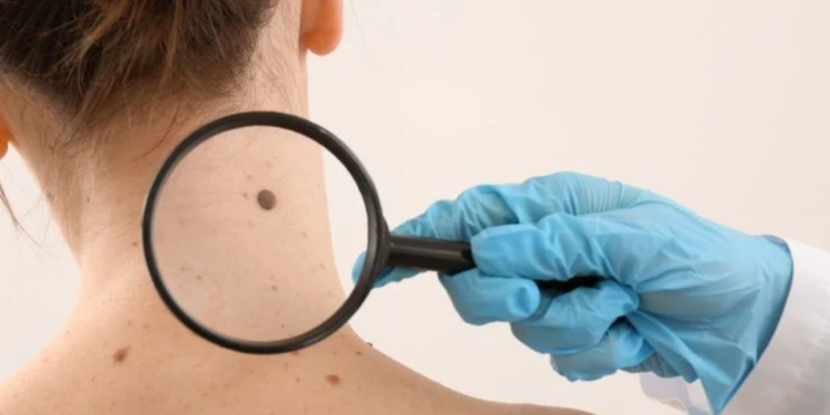 Cancer de la peau : "Je suis dermatologue et voici les 2 signes courants à détecter rapidement sur votre peau" 1 Cancer de la peau : "Je suis dermatologue et voici les 2 signes courants à détecter rapidement sur votre peau" Capture decran 2026 03 09 135304